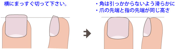 巻き 爪 の 切り 方